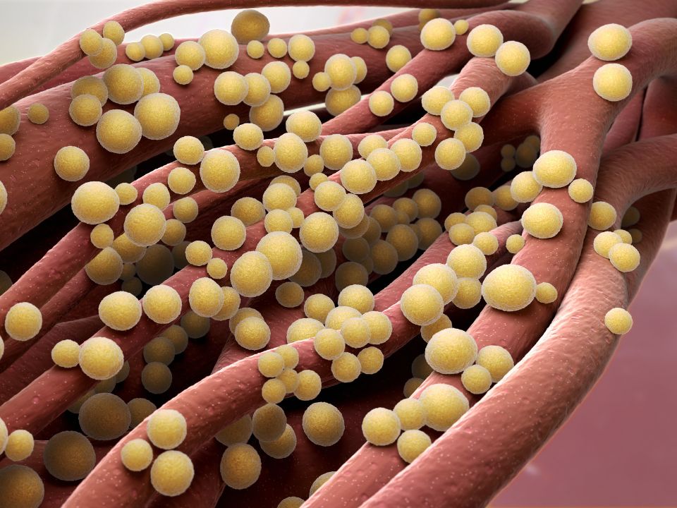Fasciíte Necrosante: conheça a infecção rara causada por bactérias comedoras de carne bactérias comedoras de carne
