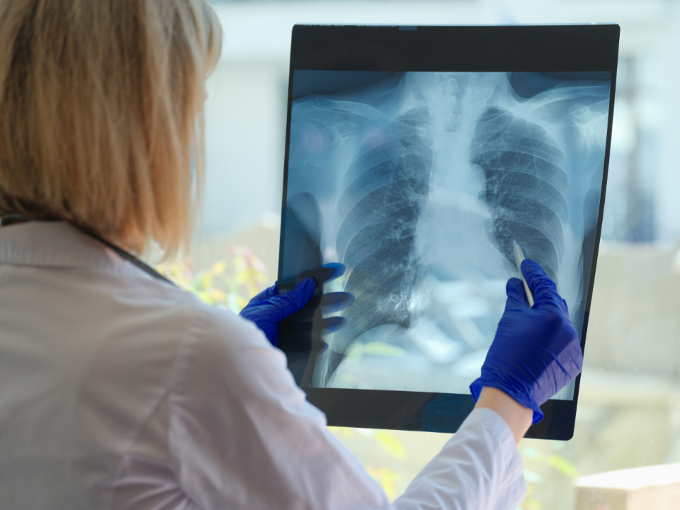 Doenças pulmonares: compreenda os riscos e como prevenir raios X demonstrando doenças pulmonares